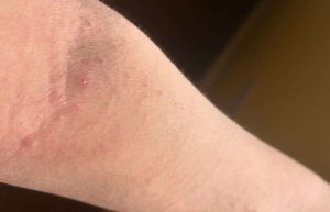 Read more about the article What is Eczema? CC’s Ultimate Guide to Itchy Skin!